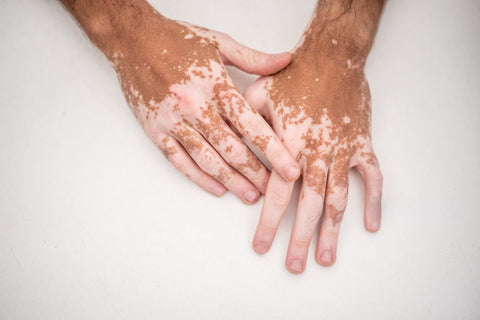 Huile de nigelle contre vitiligo
