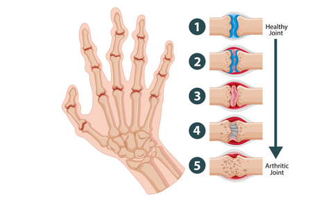 Huile de Nigelle et Arthrite (polyarthrite rhumatoïde)